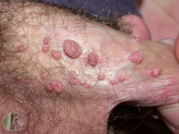 Underliv herpes Herpes simplexvirus