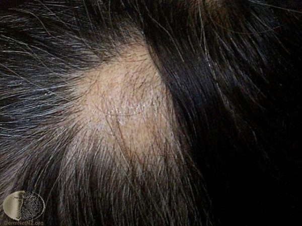 Alopecia-mucinosa