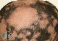 Alopecia-mucinosa