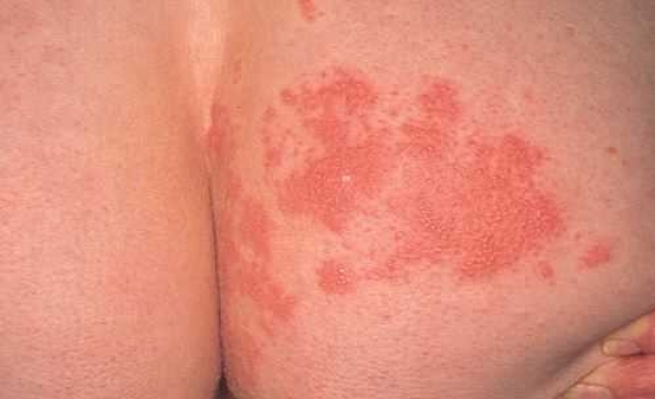 Helvetesild er et vanlig smertefullt utslett i huden som skyldes vannkoppev...