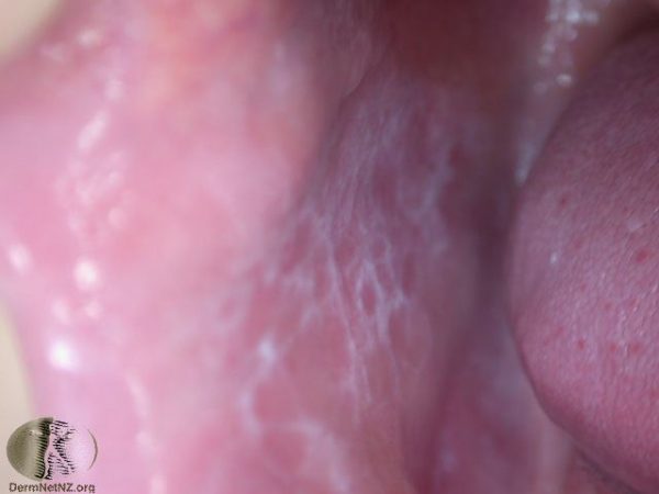Oral-lichen-planus