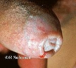 thumb-Lichen-sclerosus