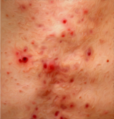 Dermatitis-herpetiformis