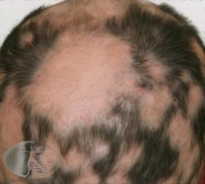 Alopecia-areata